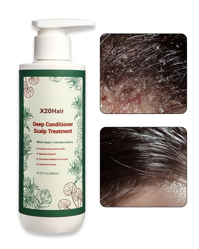 Deep Conditioner Scalp Treatment for Folliculitis - Relieves Dandruff, Psoriasis, Dryness & Itchiness, Balances Oil, Ideal for Women